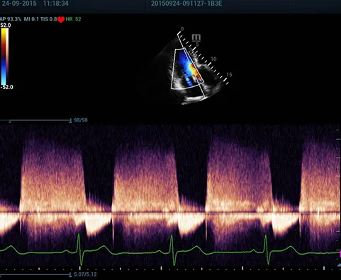 Mindray Resona 7 — Клинические изображения — фото 5