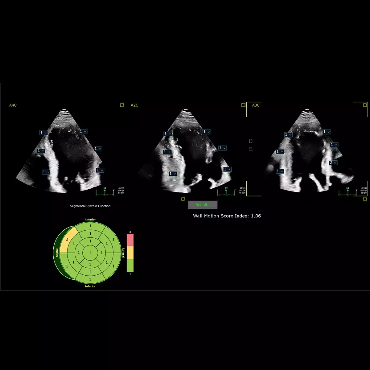 Philips EPIQ CVx — Auto Segmental Wall Motion Scoring