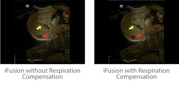 Mindray Resona 7 — iFusion с компенсацией частоты дыхания