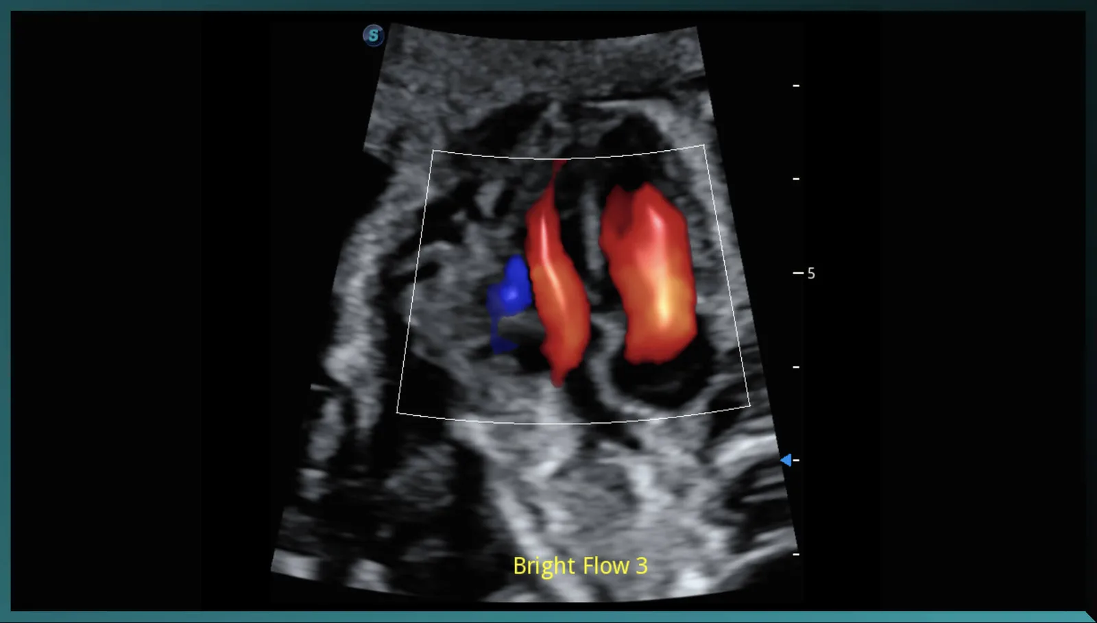 SonoScape S50 Elite — μScan+, SR-Flow, Micro F и Bright Flow — фото 4