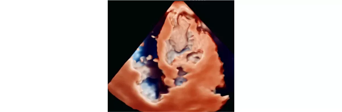 Philips EPIQ CVx — Клинические изображения EPIQ CVx — фото 4
