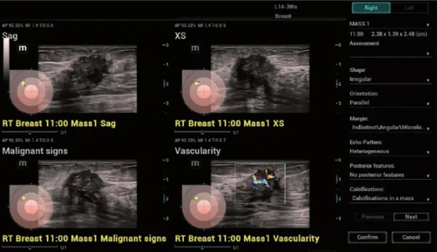 Mindray Resona I9 — Smart Breast — интеллектуальное УЗИ молочных желёз