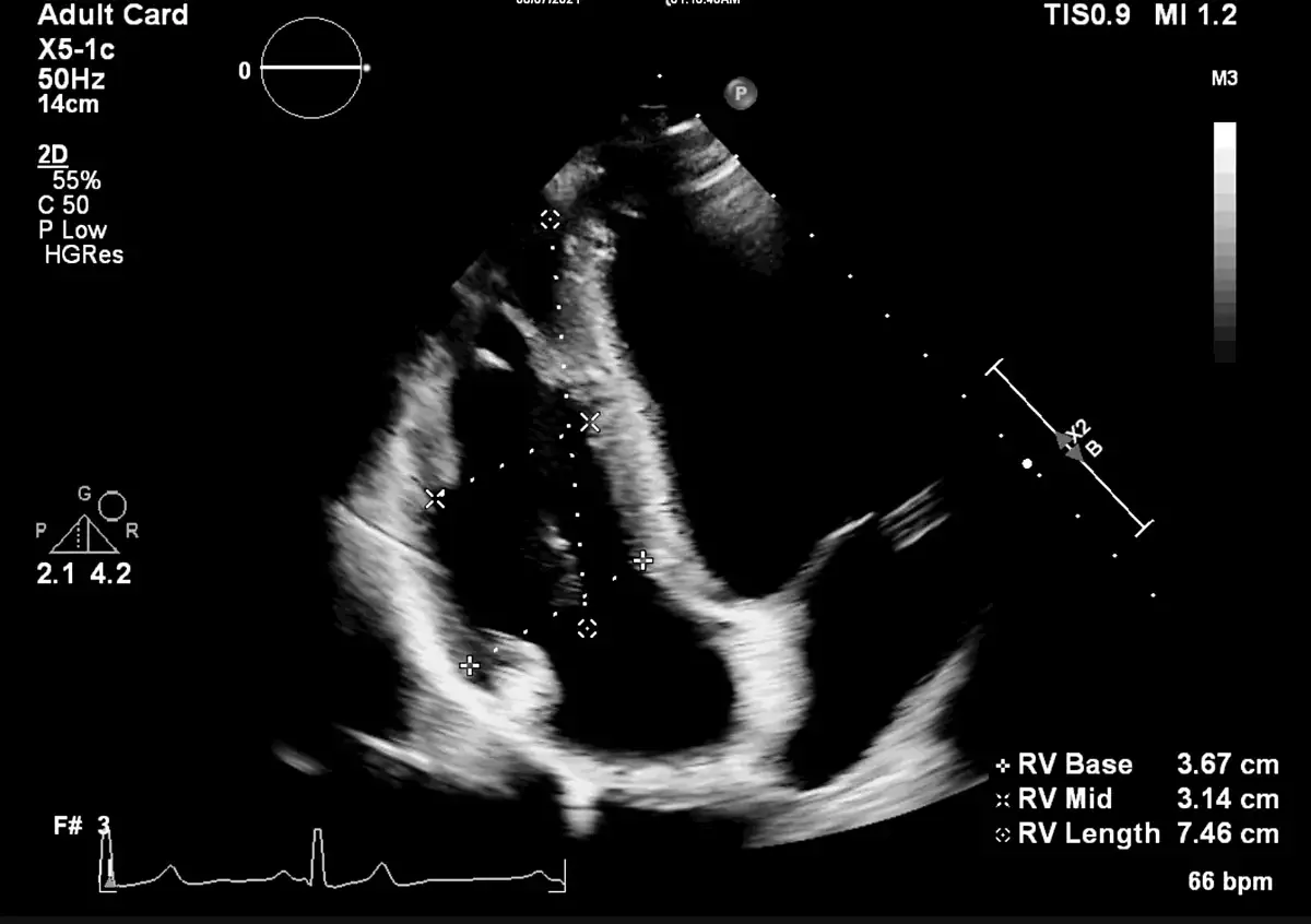 Philips EPIQ CVx — Клинические изображения EPIQ CVx — фото 1