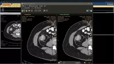 Philips IQon Spectral CT — Клинические исследования на IQon Spectral CT — фото 3
