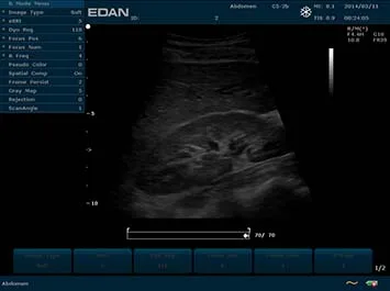EDAN U2 Prime Edition — Экран системы и клинические примеры — фото 1