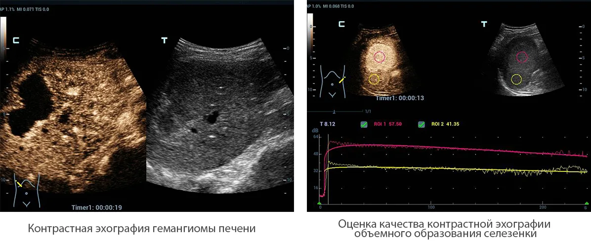 Mindray Resona 6 — Контрастная визуализация UWN+