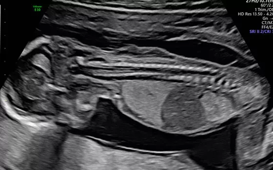 GE Voluson E10 — Uterine Trace и HDRes