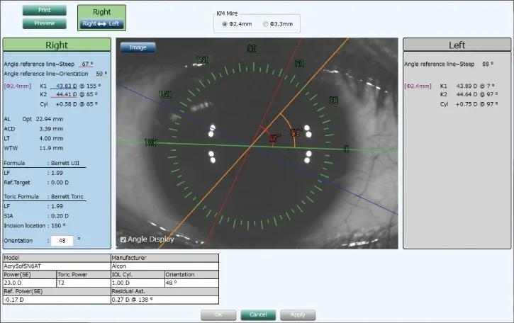 NIDEK AL-Scan — AL-Scan Viewer для NAVIS-EX