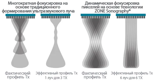 Mindray Resona 7 — Динамическая фокусировка пикселей