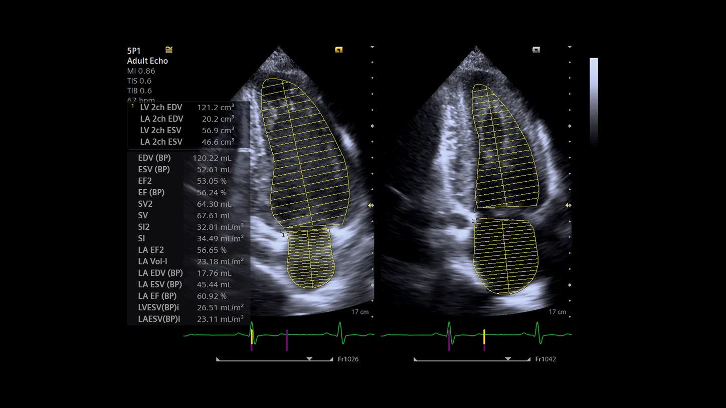 Siemens ACUSON Juniper — eSie Left Heart — измерения левых отделов