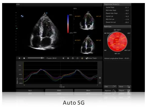 SIUI Apogee 5500 — Auto SG: количественная оценка миокарда