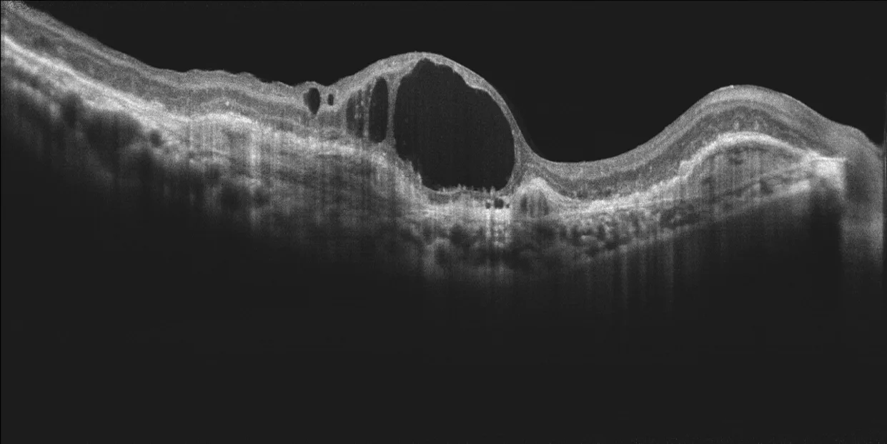 MOPTIM Mocean 3000 — Патологии сетчатки на снимках Mocean 3000 — фото 1
