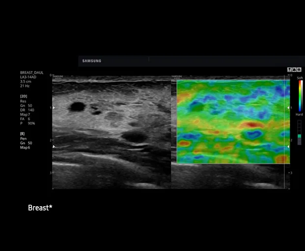 Samsung HS50 — Эластография: ElastoScan и E-Strain