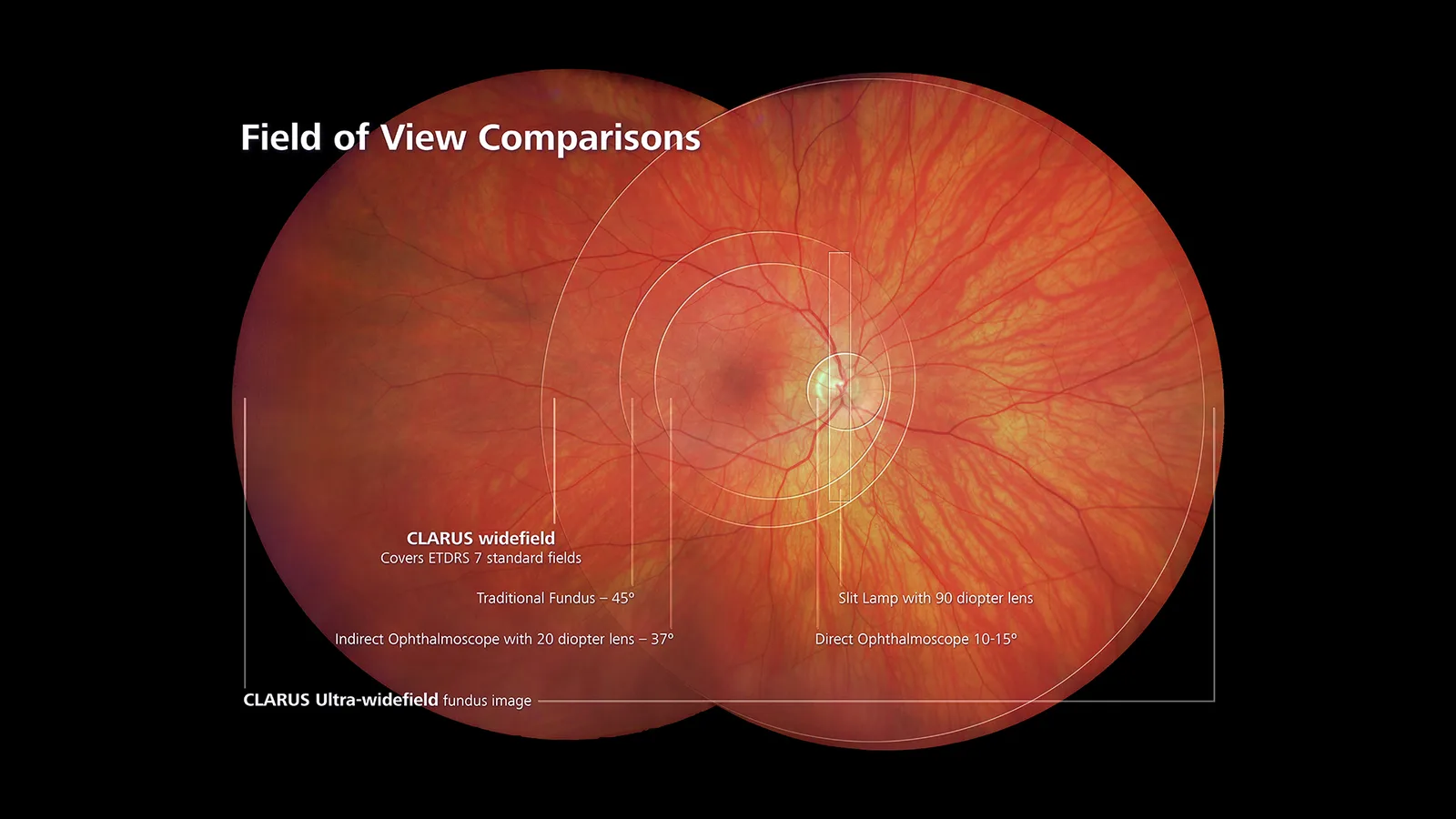 ZEISS CLARUS 500 — Поле от макулы до крайней периферии