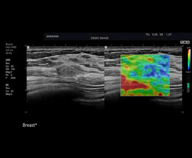 Samsung HS60 — ElastoScan: жёсткость тканей в цвете
