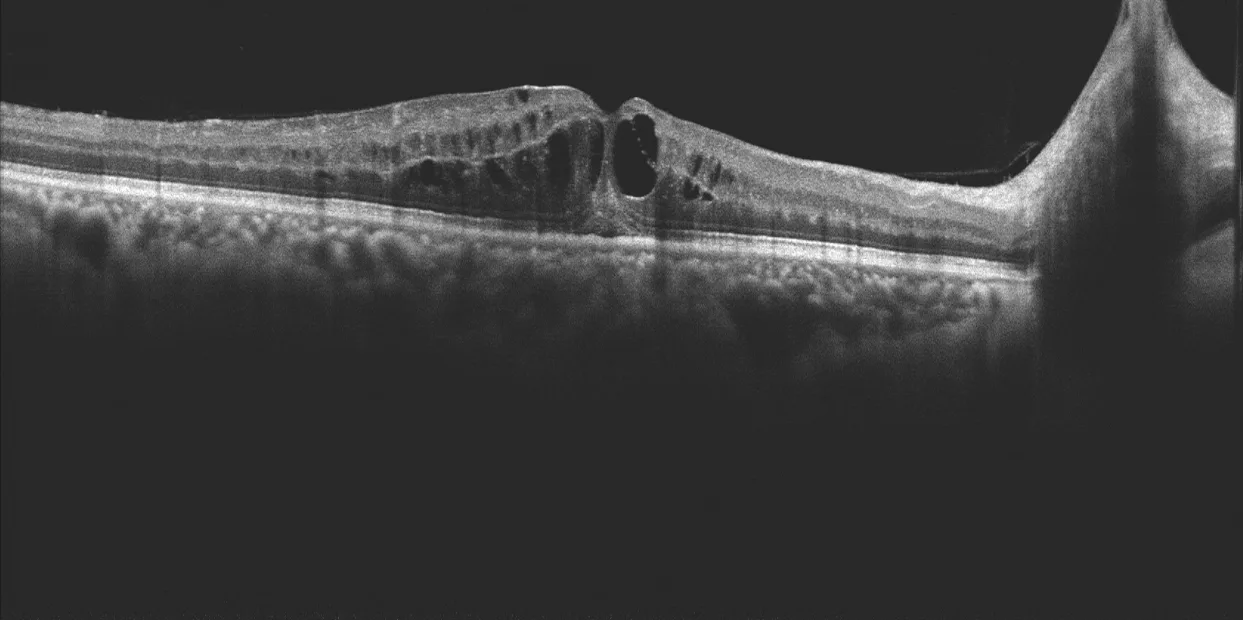 MOPTIM Mocean 3000 — Патологии сетчатки на снимках Mocean 3000 — фото 4