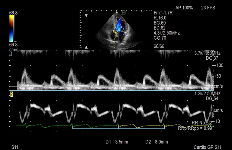 Fujifilm Arietta 750SE — Клиническая галерея Arietta 750SE — фото 3