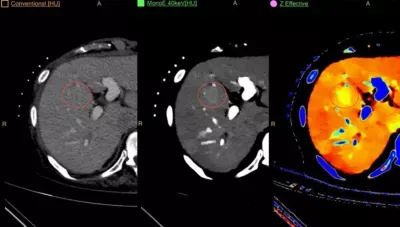 Philips IQon Spectral CT — Йодные карты и виртуальное нативное изображение