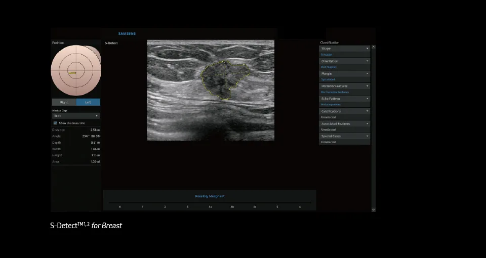 Samsung RS85 — S-Detect Breast: классификация по BI-RADS