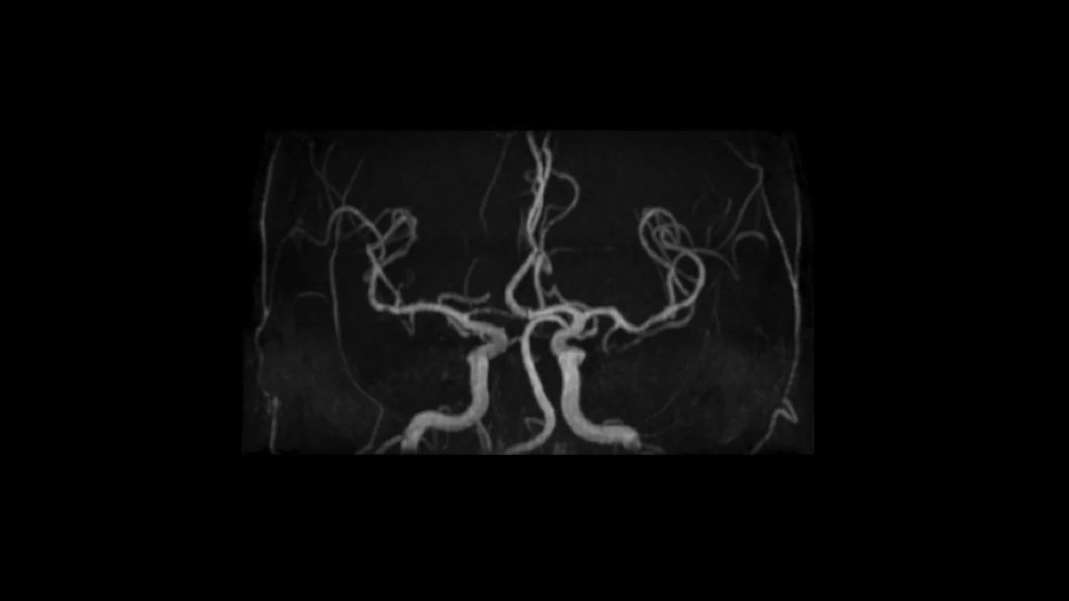GE HealthCare SIGNA Explorer 1.5T — HyperSense: сжатые измерения в рутине — фото 1
