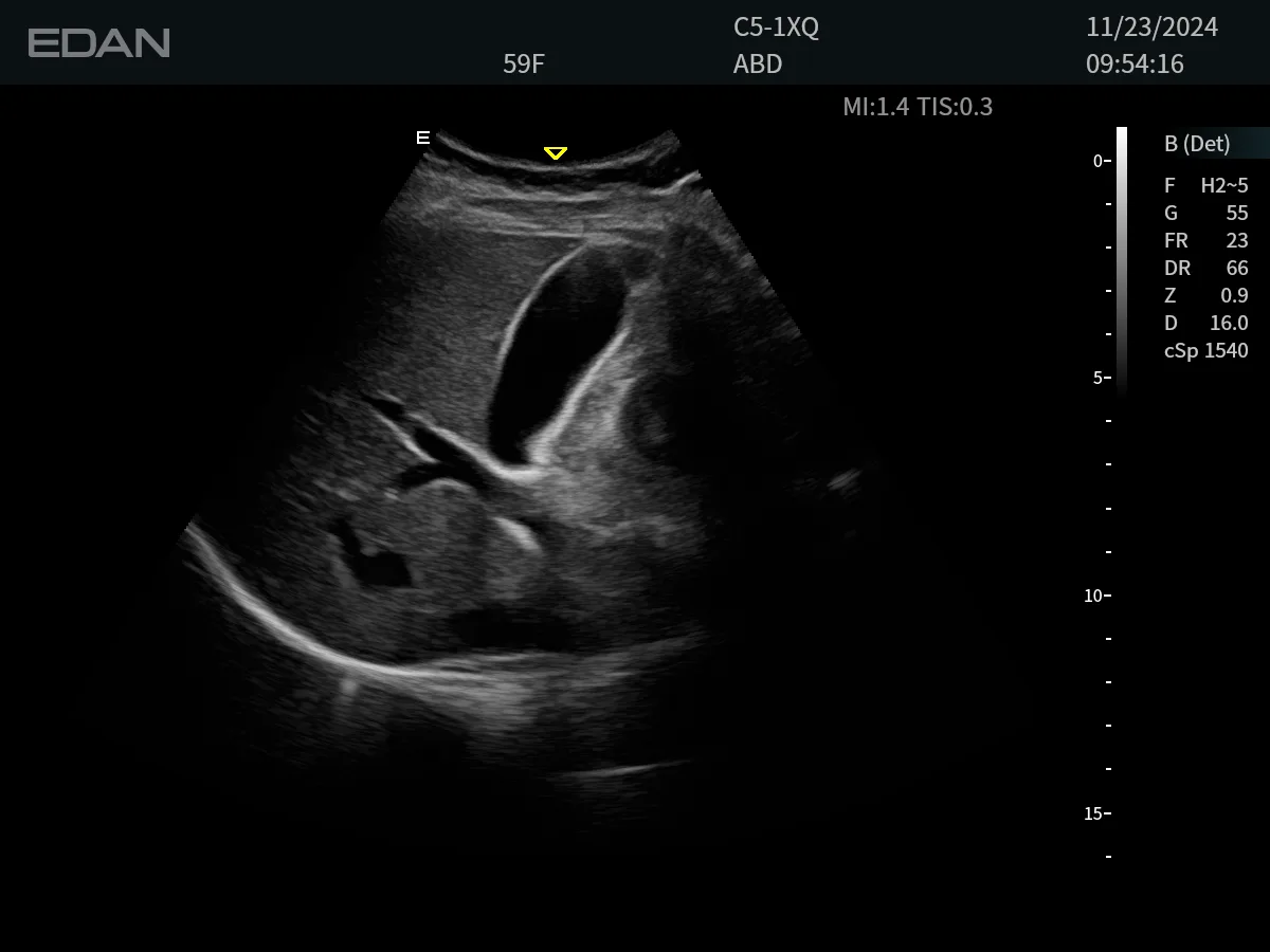 EDAN Acclarix LX85 — Клинические изображения Acclarix LX85 — фото 1