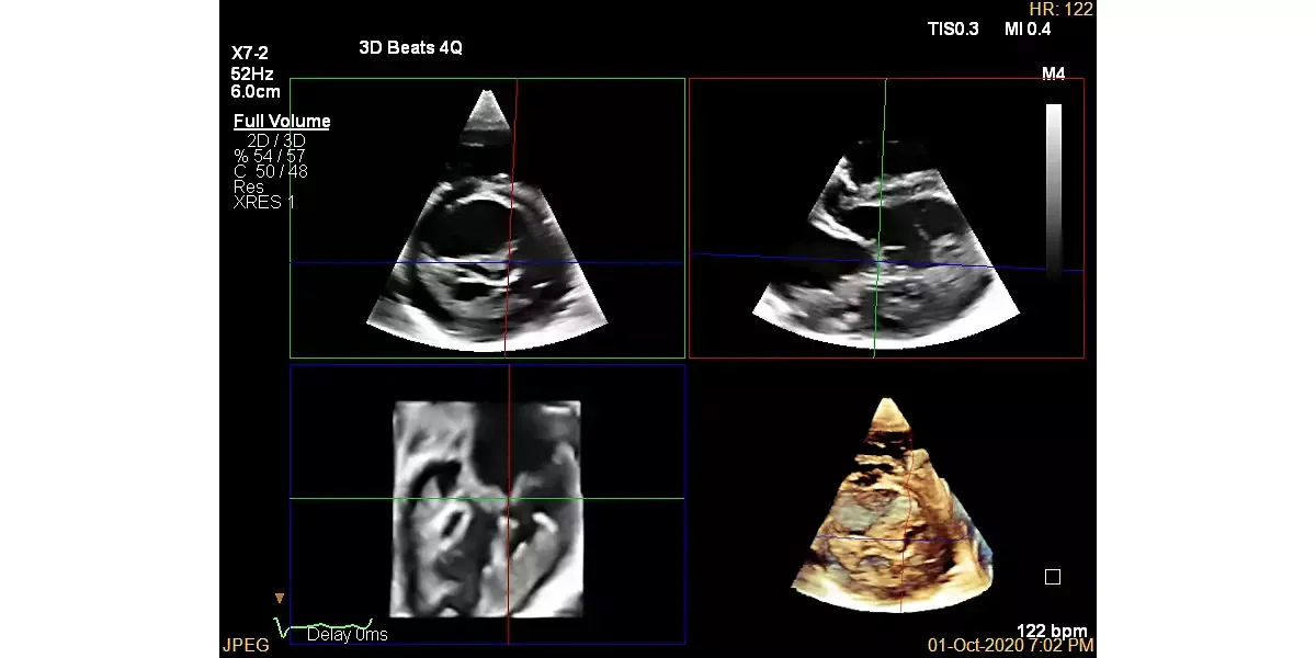 Philips EPIQ CVx — Клинические изображения EPIQ CVx — фото 7