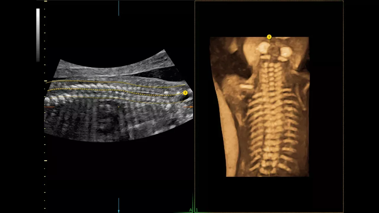 GE Voluson Signature 20 — Flow Profiles и Spine Trace: меньше нажатий