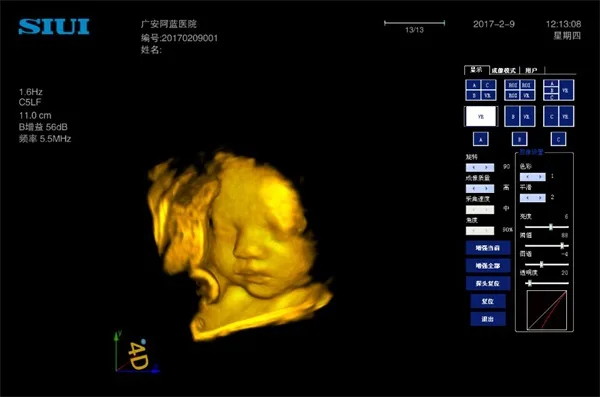 SIUI Apogee 3800 — Клинические изображения: объём и мелкие структуры — фото 1