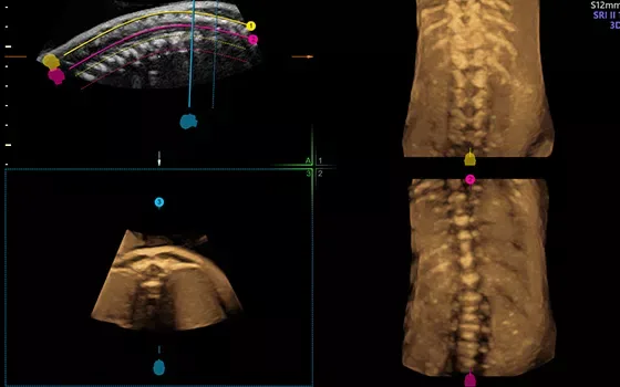 GE Voluson E8 — Объёмные инструменты: Advanced VCI и Uterine Trace