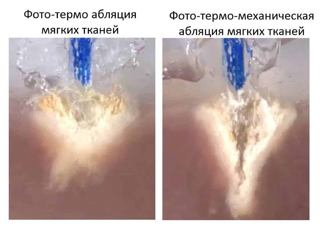 FiberLase U-MAX — Два механизма абляции мягких тканей