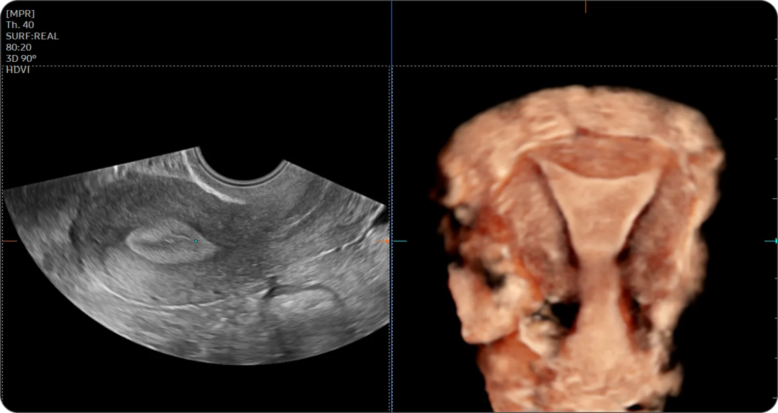 Samsung Z20 — UterineContour: коронарный срез матки