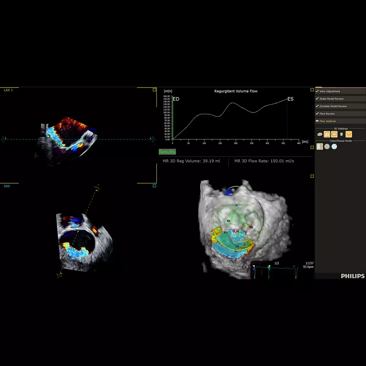 Philips EPIQ CVx — 3D Auto Color Flow Quantification