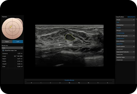 Samsung V7 — S-Detect Breast: классификация по BI-RADS