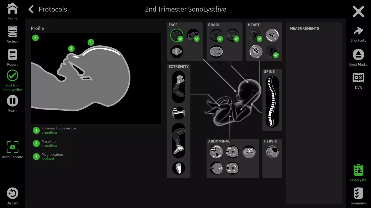 GE Voluson Signature 18 — SonoLyst и SonoCNS: ИИ в рутинных скринингах