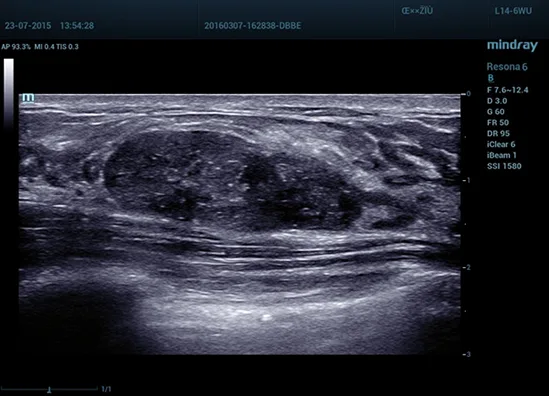 Mindray Resona 6 — Клинические изображения — фото 3