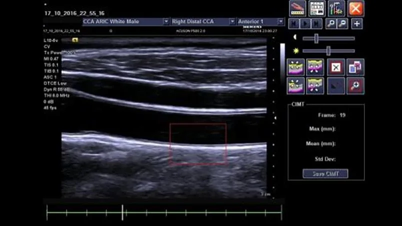 Siemens ACUSON P500 — syngo Arterial Health Package