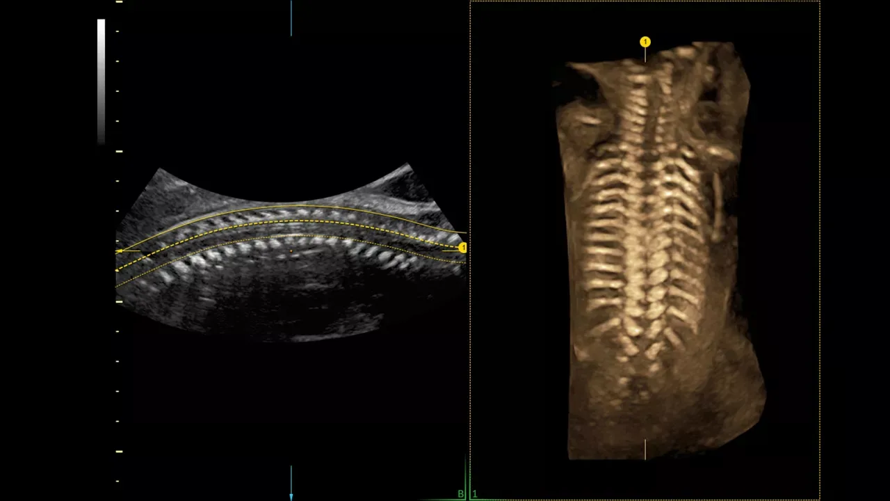 GE Voluson Signature 18 — Flow Profiles и Spine Trace: меньше нажатий