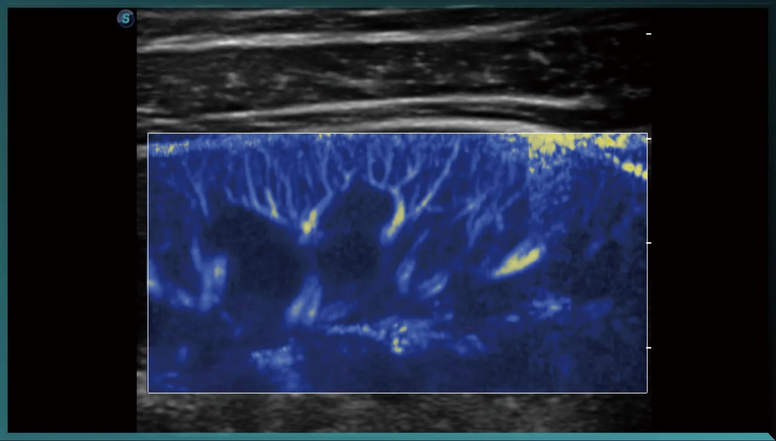 SonoScape S50 Elite — μScan+, SR-Flow, Micro F и Bright Flow — фото 3