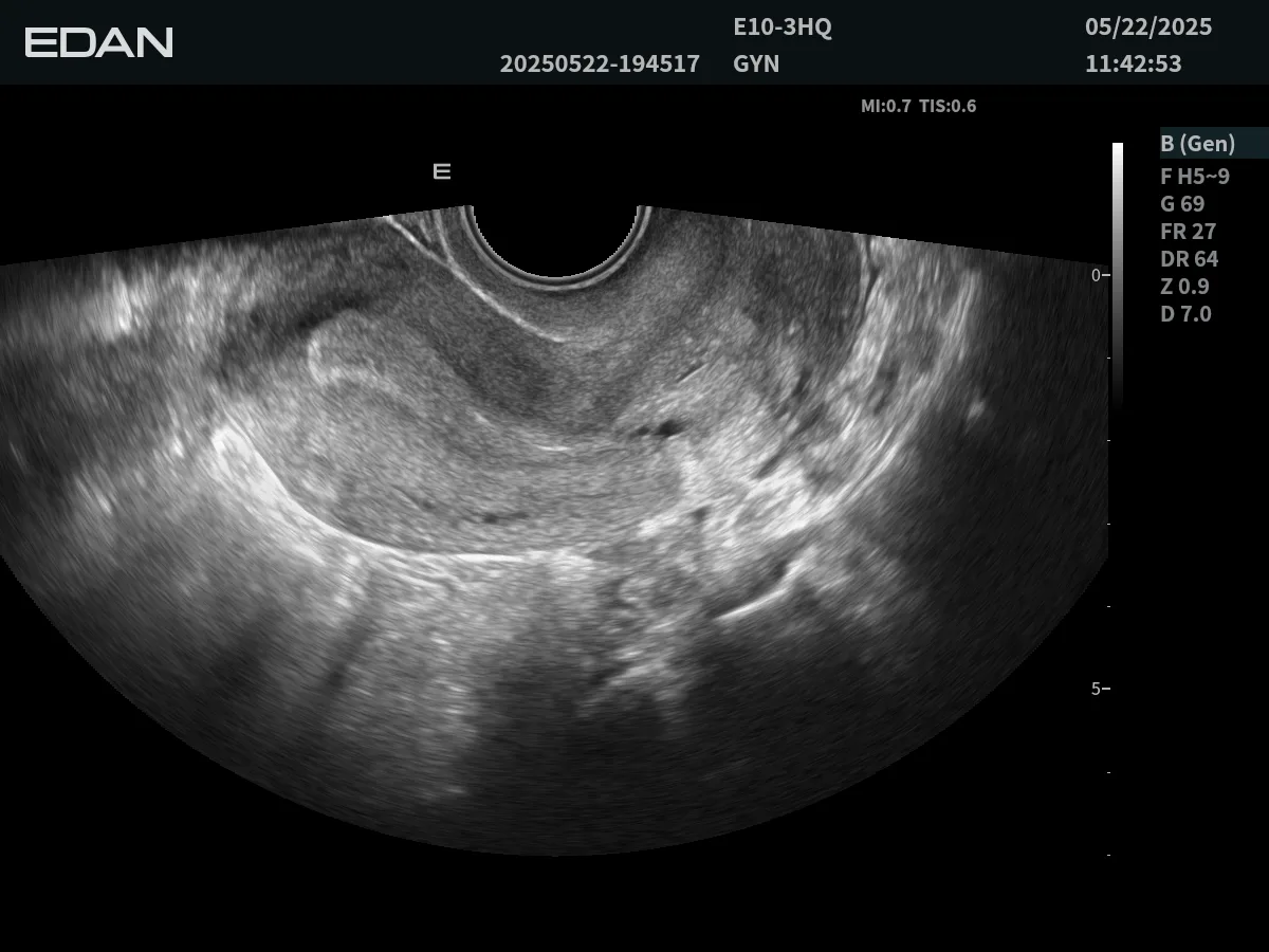 EDAN Acclarix LX85 — Клинические изображения Acclarix LX85 — фото 4