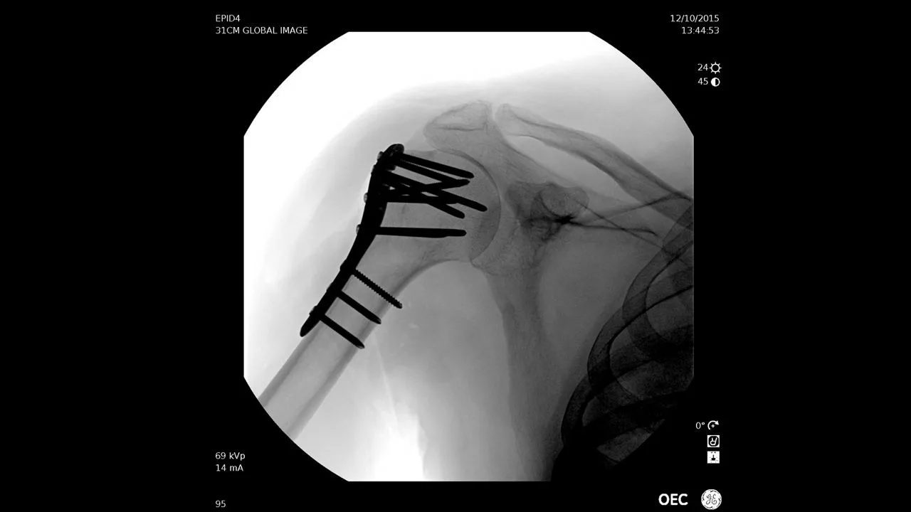 GE HealthCare OEC Elite CFD — Снимки, сделанные на OEC Elite — фото 2