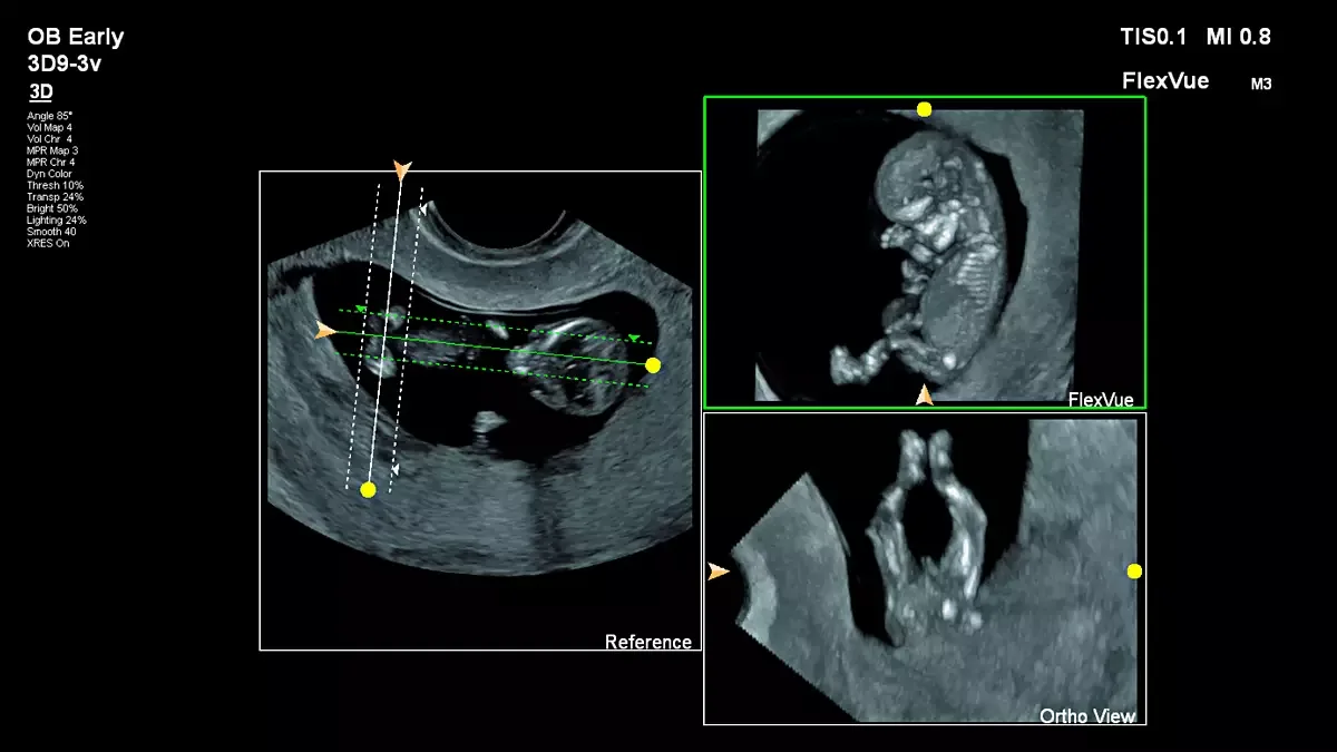 Philips Affiniti 50 — FlexVue и Orthogonal View