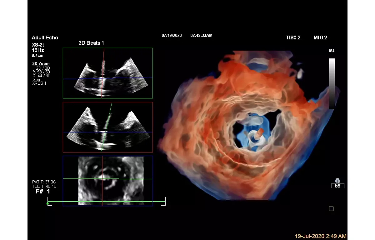 Philips EPIQ CVx — TrueVue и Dynamic HeartModel