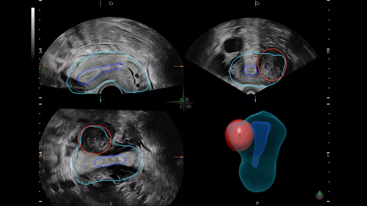 GE Voluson Signature 20 — SonoGYN и SonoPelvicFloor: гинекология по стандартам