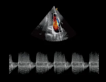 CHISON QBit 9 — Кардиология: от аортального клапана до сосочковых мышц — фото 4