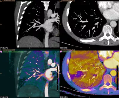 Philips IQon Spectral CT — Низкие keV: контраст там, где его мало
