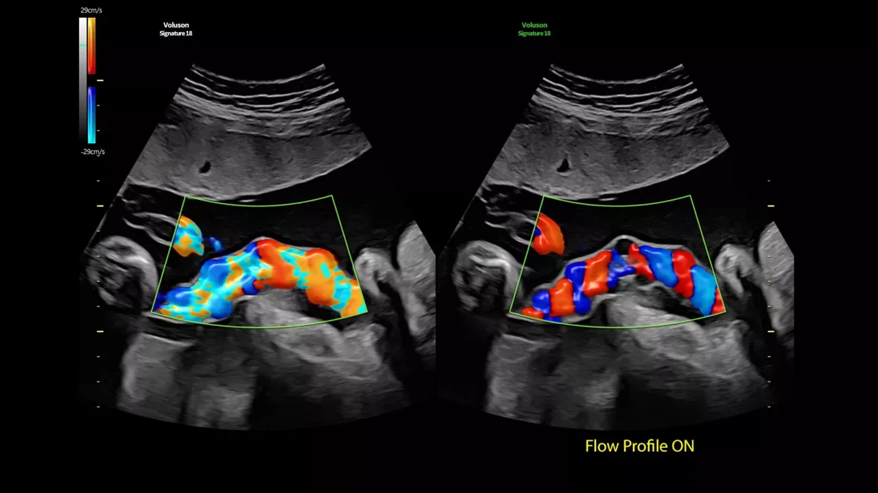 GE Voluson Signature 18 — Flow Profiles и Spine Trace: меньше нажатий