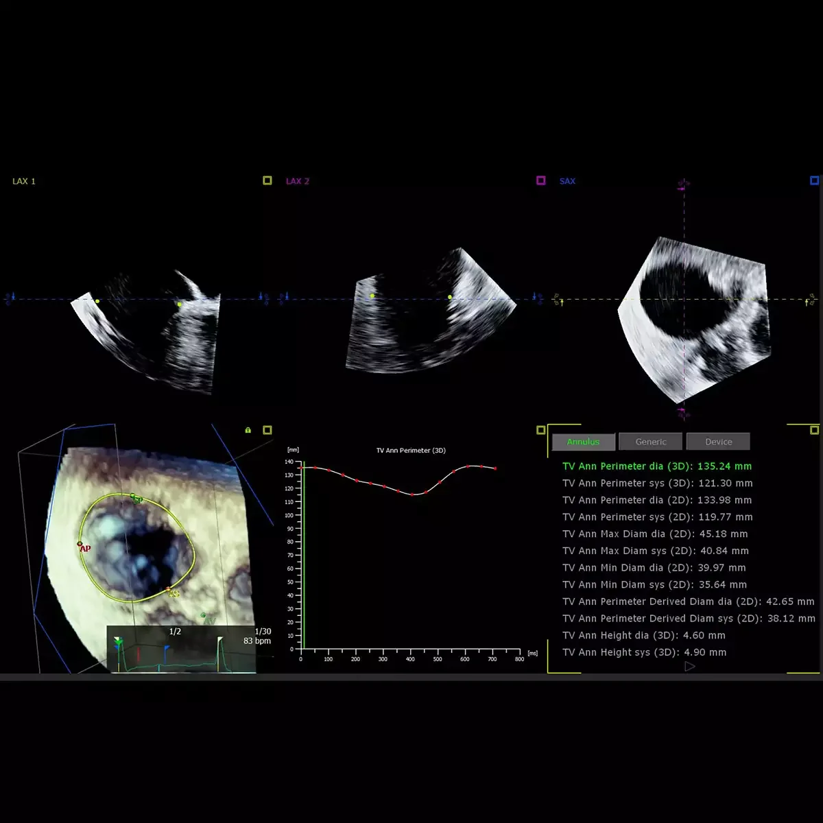 Philips EPIQ CVx — 3D Auto Tricuspid Valve Quantification