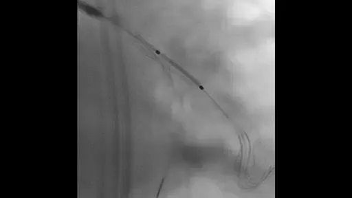 Siemens ARTIS Q.zen — CLEARstent Live: стент виден при установке