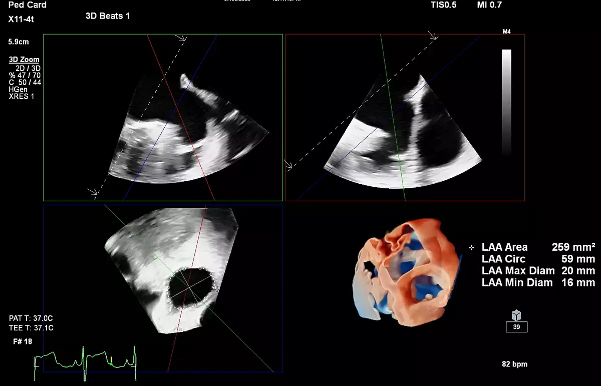 Philips EPIQ CVx — Клинические изображения EPIQ CVx — фото 6