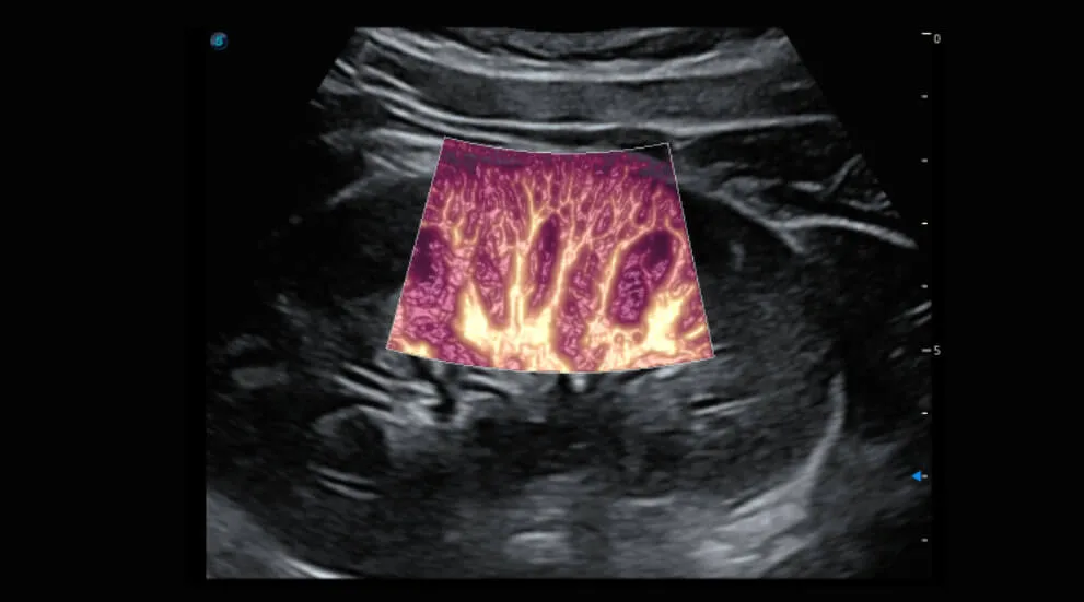 SonoScape P50 Elite — μScan+, SR-Flow, Micro F и Bright Flow — фото 4